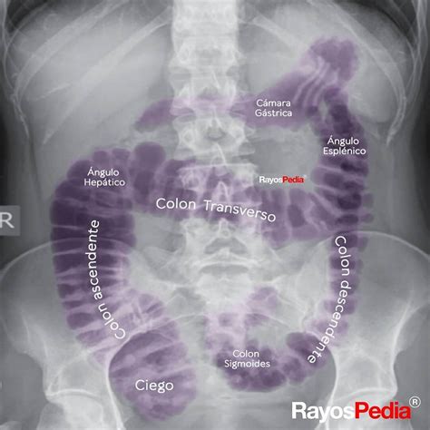 Radiografía de abdomen de un lactante con patrón de aireación intestinal inespecífico y hepatomegalia