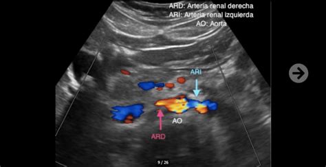 Ecografía Doppler mostrando trombosis de la vena renal en un neonato