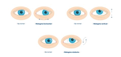 Esquema de los diferentes tipos de nistagmo (horizontal, vertical, rotatorio) y cómo se manifiestan los movimientos oculares