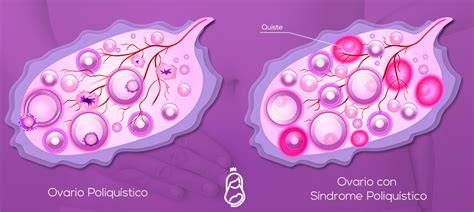 Fisiopatología del Síndrome de Ovarios Poliquísticos (SOP)