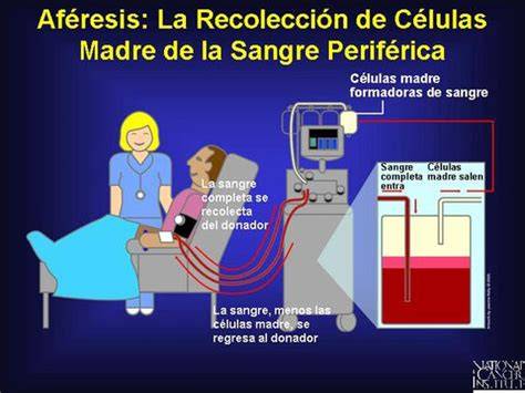 Ilustración del proceso de aféresis para la recolección de células madre de sangre periférica.