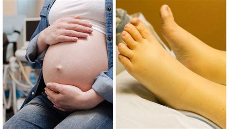 Edema en embarazo: manos y pies hinchados