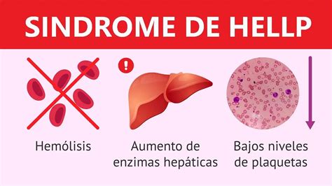 Infografía: Síndrome HELLP y sus síntomas