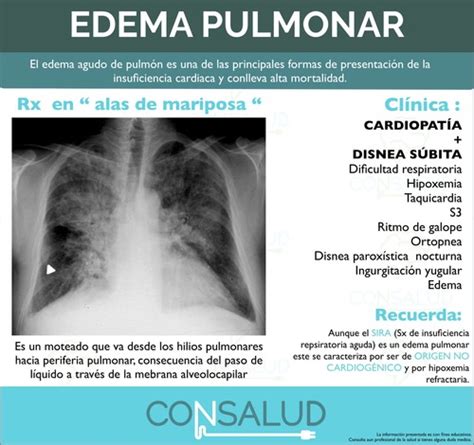 Radiografía de tórax mostrando edema agudo de pulmón