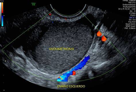 Ecografía transvaginal mostrando un endometrioma