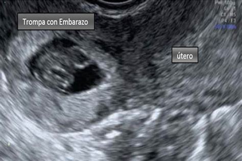 Imagen de una ecografía mostrando un embarazo ectópico en la trompa de Falopio