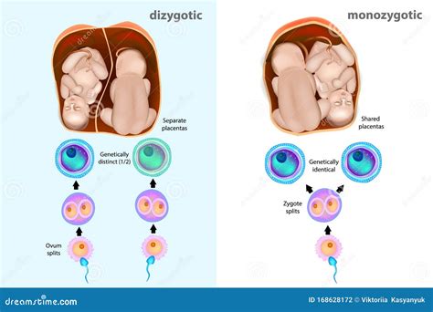 Infografía comparativa de los riesgos y complicaciones en embarazos de gemelos monocigóticos y dicigóticos.
