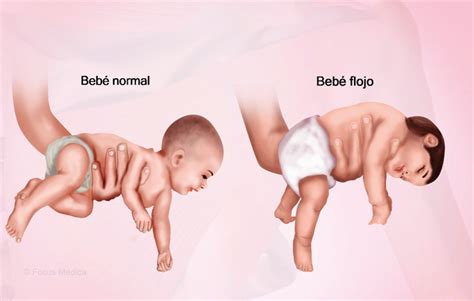 Comparativa visual de un bebé con hipotonía (flácido) y un bebé con hipertonía (tensión muscular visible).