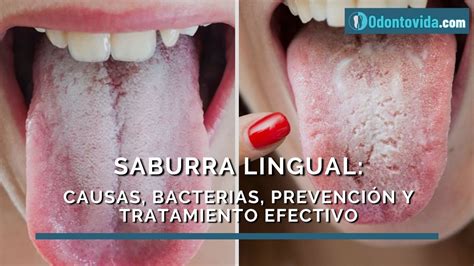 Foto de una lengua con saburra, principal causa de halitosis oral