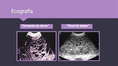 Ecografía que muestra la apariencia de 