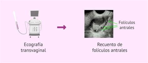 Ecografía transvaginal mostrando folículos antrales
