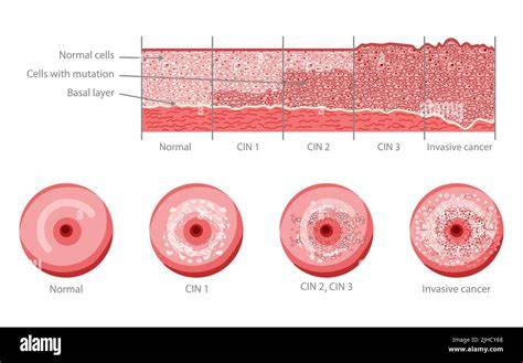 Diagrama mostrando los diferentes grados de hipoplasia mamaria: leve, moderada, severa, con sus características distintivas.