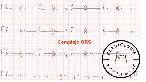 Ejemplo de un electrocardiograma mostrando un complejo QRS ancho de una extrasístole ventricular