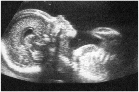 Ecografía fetal mostrando mediciones de biometría para estimación de peso