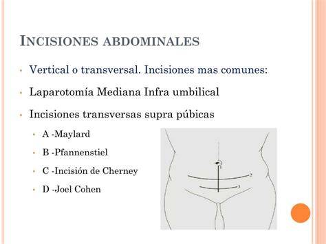Esquema detallado de los diferentes tipos de incisiones de cesárea: transversal baja (Pfannenstiel), vertical baja y vertical alta, con énfasis en su ubicación