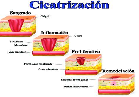 Diagrama infográfico mostrando las tres fases de cicatrización de una herida: inflamación, proliferación y remodelación, con ilustraciones de cada etapa