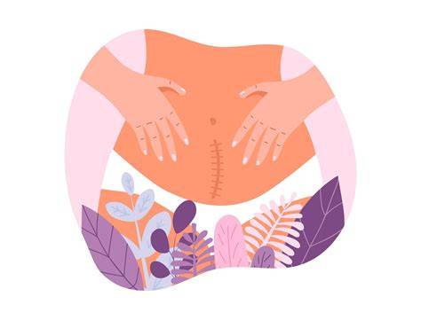 Ilustración de una mujer aplicando suavemente un paño frío sobre su cicatriz de cesárea para aliviar la picazón