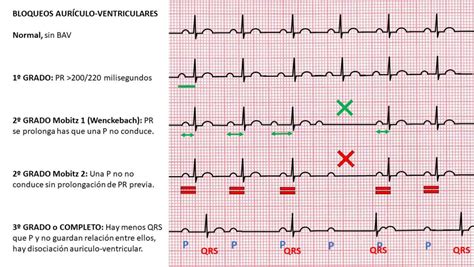 Diagrama de un ECG mostrando diferentes tipos de bloqueo AV