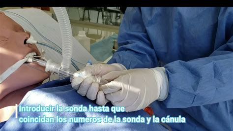 Diagrama de la técnica de aspiración endotraqueal cerrada en un paciente neonato