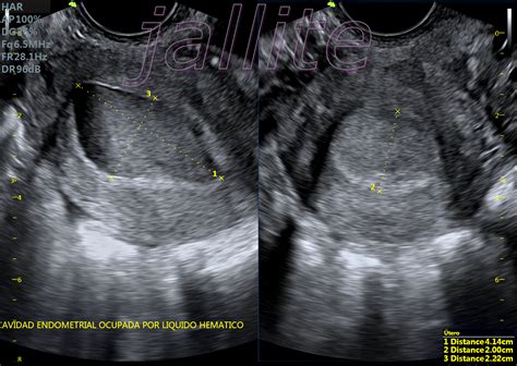 Esquema de un ultrasonido pélvico mostrando restos uterinos