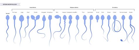 Gráfico comparativo de un espermatozoide normal y uno con defectos morfológicos.