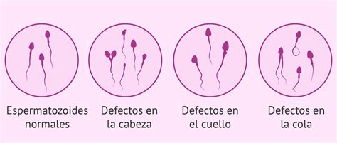 Ilustración mostrando diferentes tipos de cabezas de espermatozoides anómalos: globozoospermia, cabeza de alfiler, cabeza piriforme.