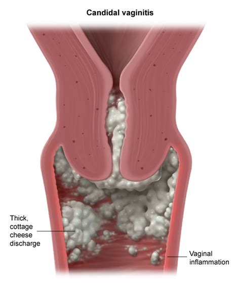 Ilustración médica mostrando la anatomía femenina y la zona vulvovaginal afectada por candidiasis.