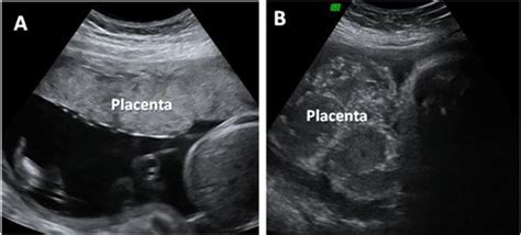 Imagen de ecografía obstétrica mostrando la placenta previa.