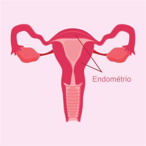 Esquema del útero con el endometrio inflamado