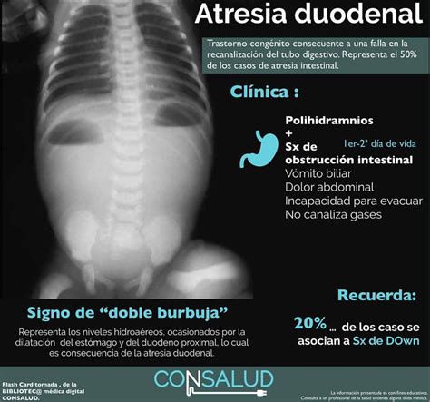 Radiografía abdominal mostrando el signo de la doble burbuja en un neonato