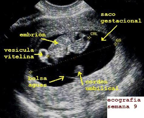 imagen de ecografía transvaginal mostrando el saco gestacional, la vesícula vitelina y el embrión con latido cardíaco.