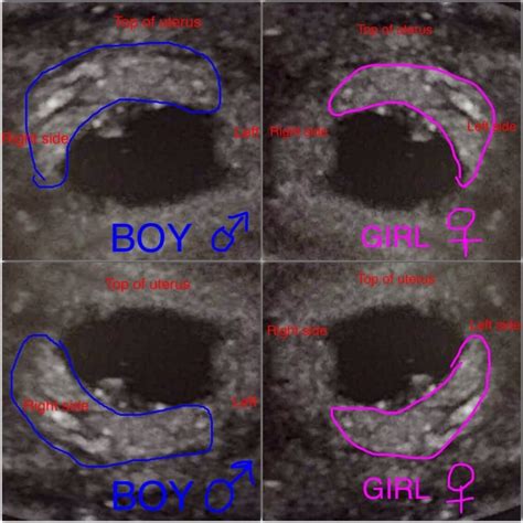 esquema explicativo del método Ramzi, mostrando ecografías transvaginales con la placenta en el lado derecho e izquierdo, y su supuesta relación con el sexo del bebé.