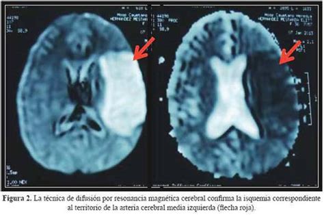 Imágenes de resonancia magnética que muestran un accidente cerebrovascular isquémico arterial en un neonato.
