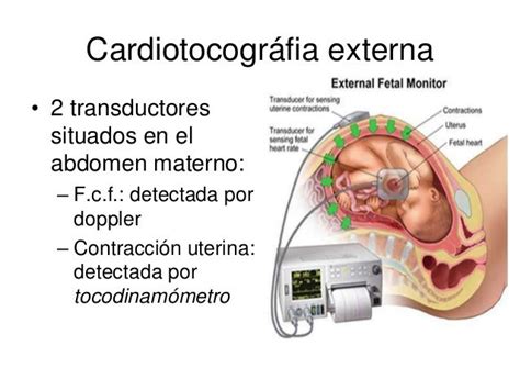 Diagrama comparativo entre monitoreo externo (sensores abdominales) y monitoreo interno (electrodo en el cuero cabelludo fetal).