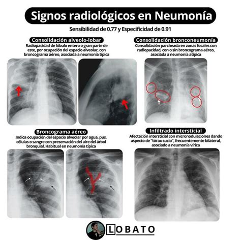 Radiografía de un cachorro mostrando signos de neumonía (infiltrados pulmonares).