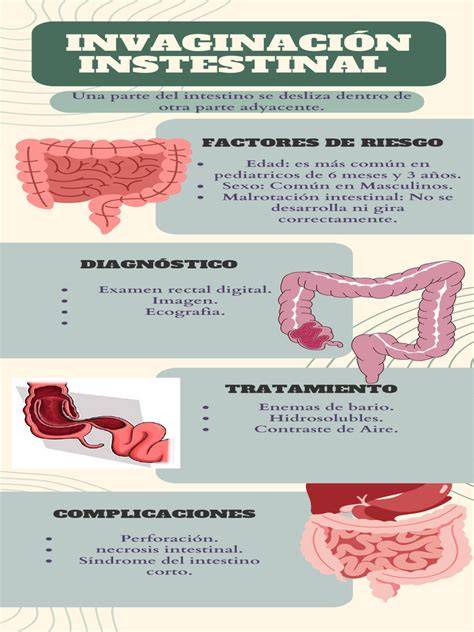 Diagrama explicativo de la invaginación intestinal