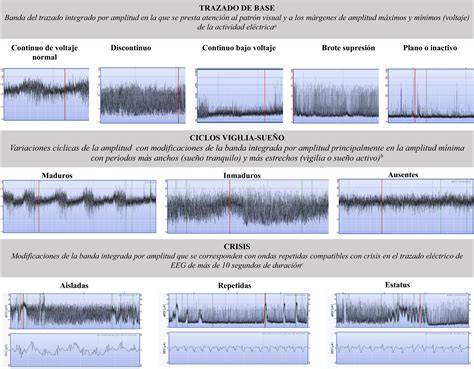 Ejemplo de trazado de electroencefalograma integrado por amplitud (aEEG) con diferentes patrones