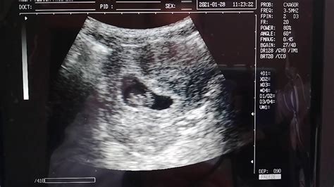Ecografía transrectal de un embrión bovino en las primeras etapas de gestación