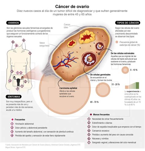 Esquema anatómico mostrando la diseminación del cáncer de ovario hacia el peritoneo y ganglios linfáticos