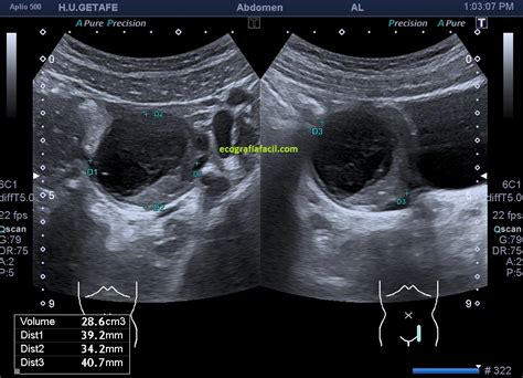 Imágenes de ecografía transvaginal mostrando un quiste ovárico simple