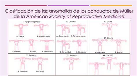 Infografía mostrando ejemplos de anomalías congénitas del aparato reproductor femenino, como el útero bicorne o himen imperforado.