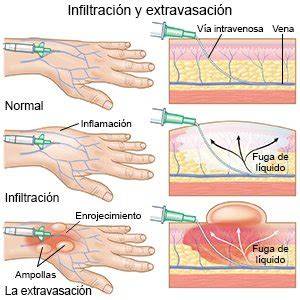 Diagrama ilustrativo de las diferencias entre infiltración y extravasación, con ejemplos de tejidos afectados.