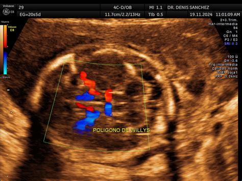 Infografía comparativa: ecografía frente a RM fetal mostrando la resolución de estructuras cerebrales como los surcos corticales.