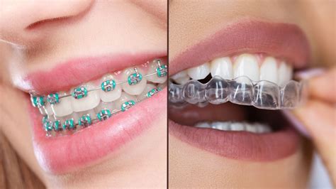 Esquema comparativo de brackets tradicionales y alineadores invisibles en ortodoncia