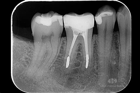 Radiografía periapical mostrando un molar ectópico impactando un molar deciduo