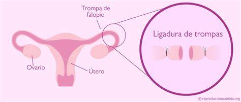 Esquema de las trompas de Falopio y los puntos de ligadura