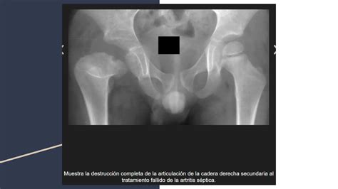 Radiografía de cadera de un lactante con artritis séptica