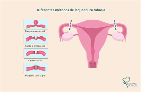 Diagrama de los diferentes métodos de ligadura tubárica (corte, cauterización, salpingectomía)