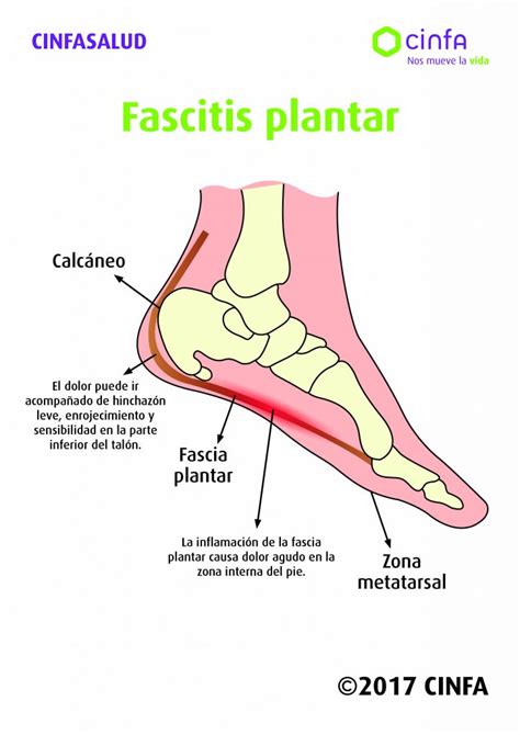 Diagrama de las zonas de dolor en el pie por fascitis plantar