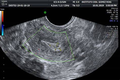 Ecografía del útero mostrando un aborto espontáneo
